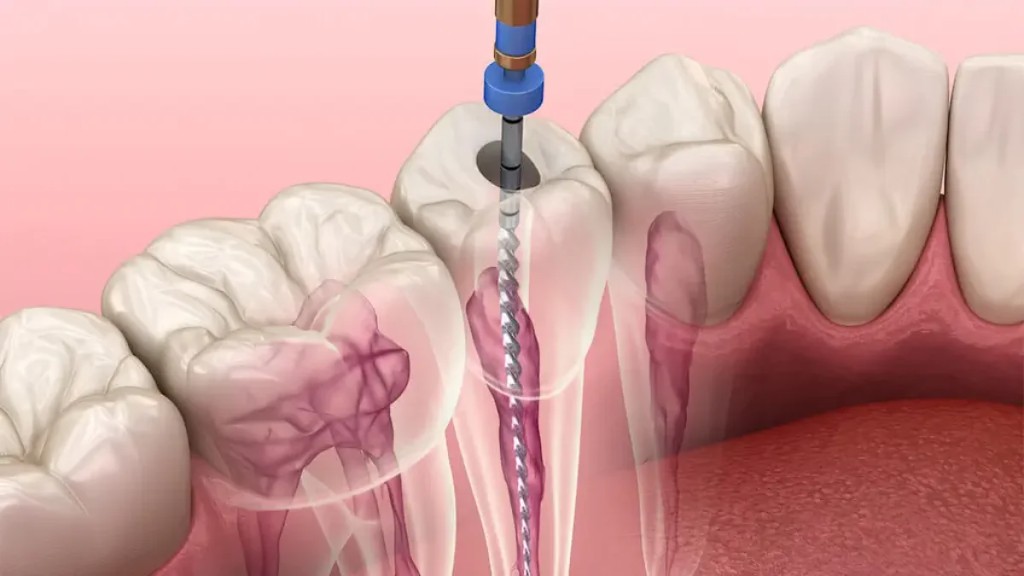 Endodontie — traitement des canaux