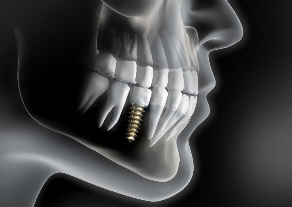 Implant dentaire — implantologie