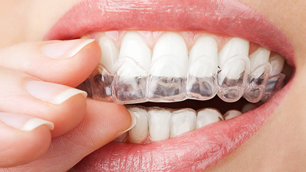 Orthodontie — aligneurs transparents